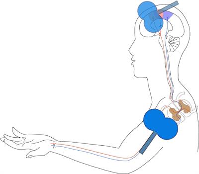 Using Hebbian-Type Stimulation to Rescue Arm Function After Stroke: Study Protocol for a Randomized Clinical Trial